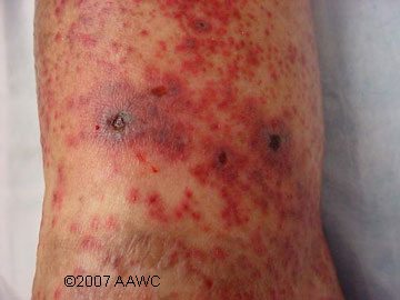 Vasculitis - Neuromuscular Home Page
